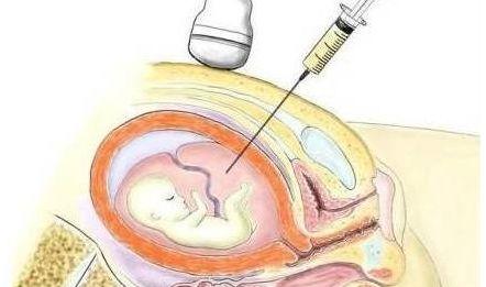 羊水穿刺示意圖