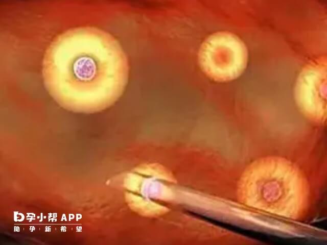 試管卵泡少只有5個應進行卵泡監測