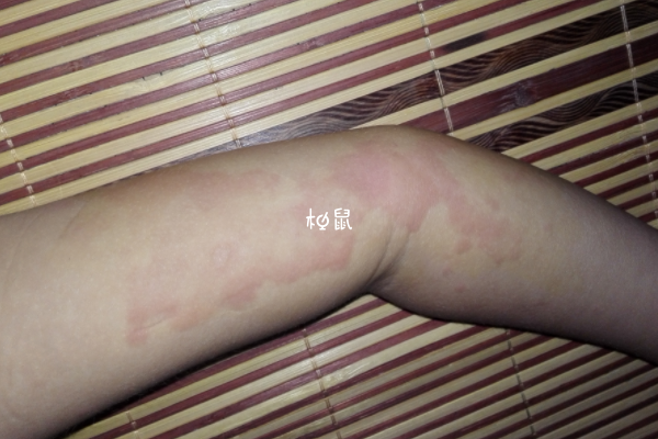 孕期過敏性蕁麻疹不能亂用藥