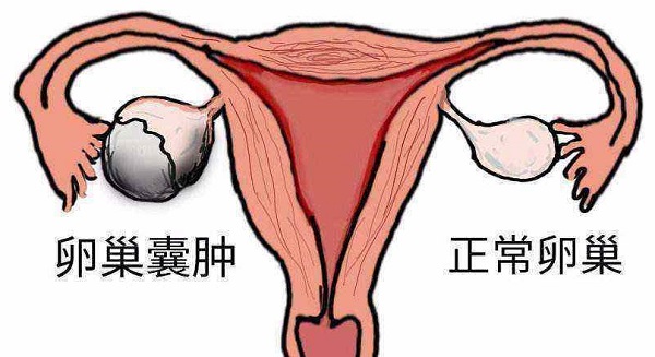 卵巢囊腫不宜用dhea進行治療