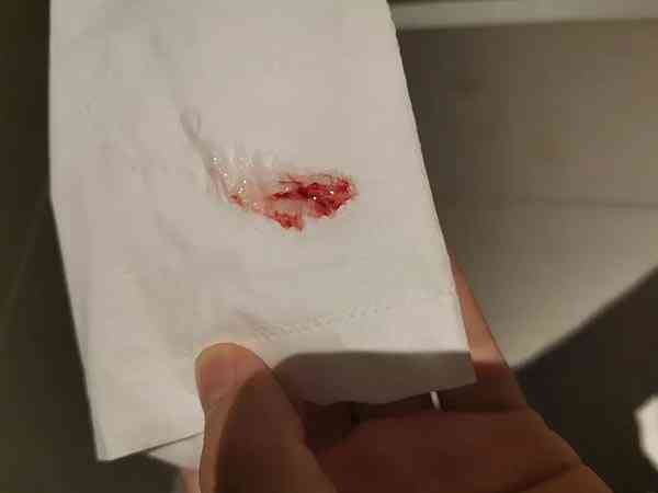排卵期出血并非好于怀