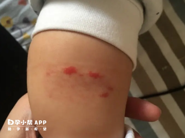 嬰兒毛細血管瘤