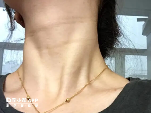 孕婦脖子變黑判斷生男生女不準