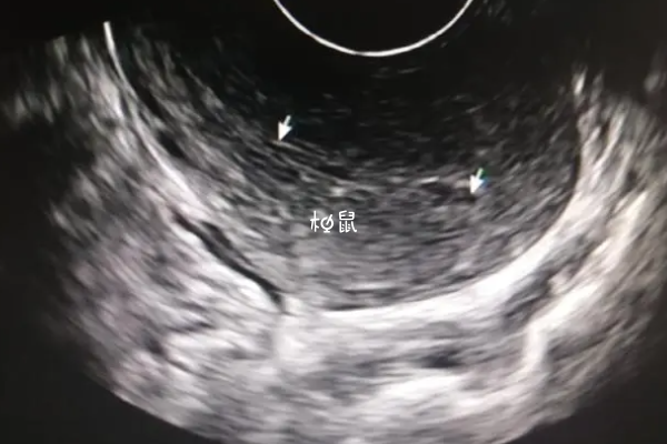 卵泡生长缓慢有很多原因