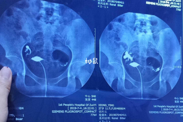 输卵管造影手术过比较简单