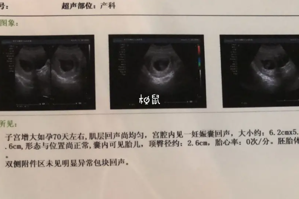 没有胎心可能就是胎停了