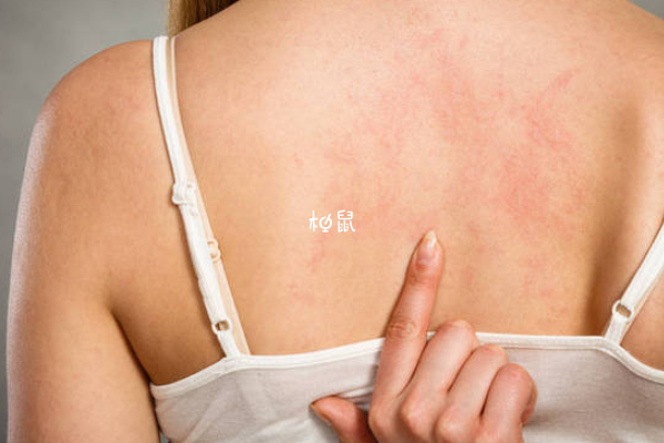 孕期預防蕁麻疹要注意天氣變化