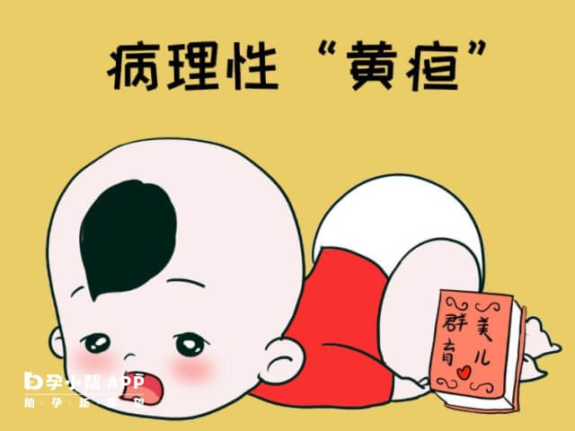 孕期饮食清淡可以避免病理性黄疸