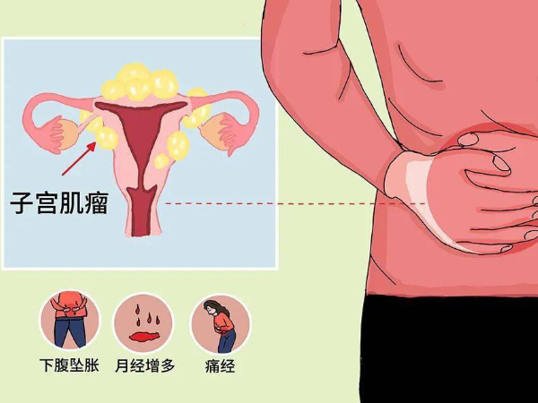 避免肥胖能預防子宮肌瘤