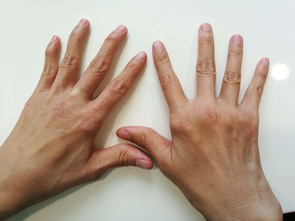 類風溼關節炎可用地塞米松注射液治療