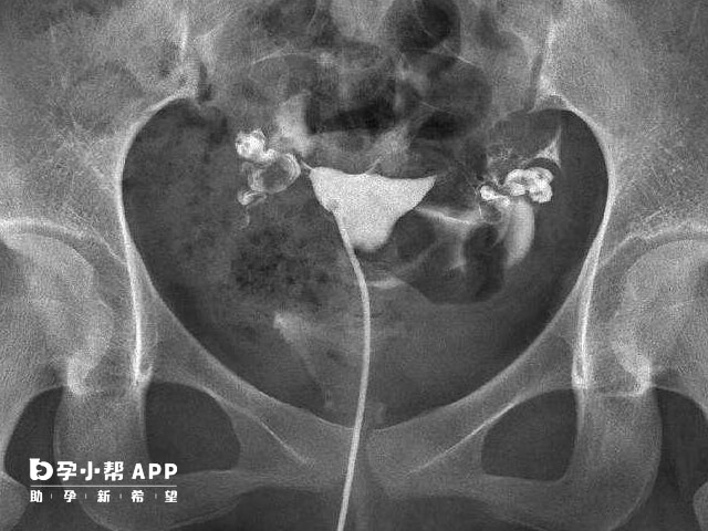 輸卵管堵塞4個自查方法