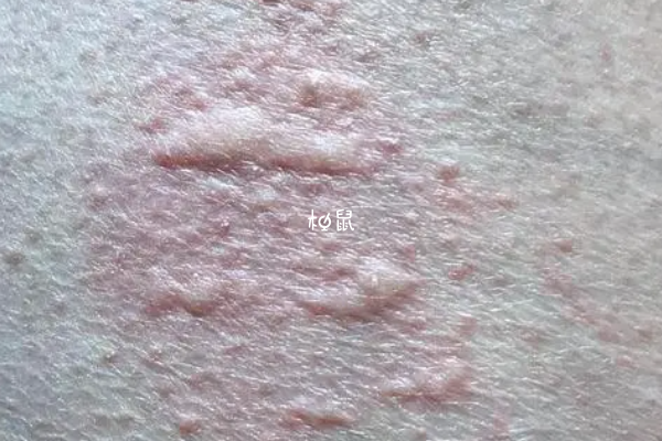 懷孕期間得了過敏性蕁麻疹要確定過敏原