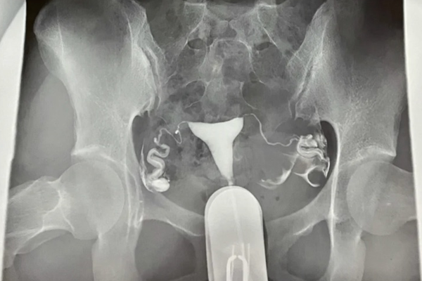 有不孕情況可查造影