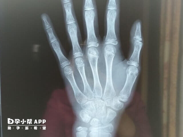 小孩骨齡可以看出以後身高