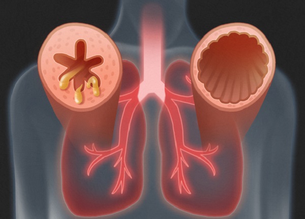 不當使用地塞米松注射液會引發哮喘