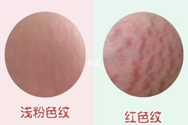 从裂纹的颜色判断妊娠纹