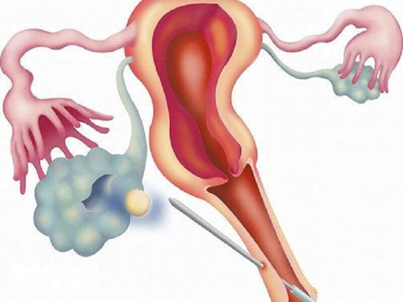 夜針後36小時左右就可以取卵