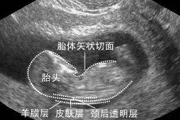 胎體矢狀切面圖