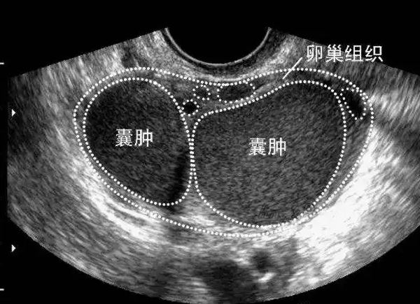 巧克力囊腫做試管並不難
