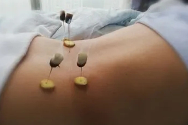 月子去寒氣可以進行鍼灸
