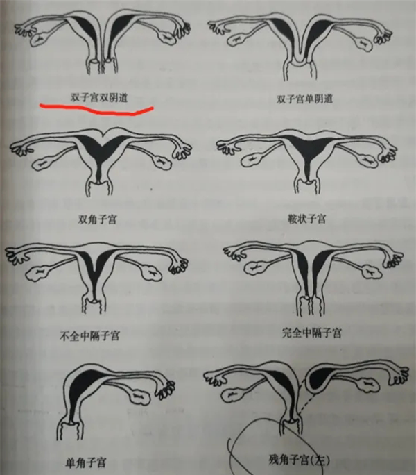 子宮畸形是能夠生孩子的