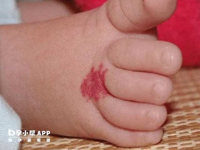 新生兒最最常見胎記