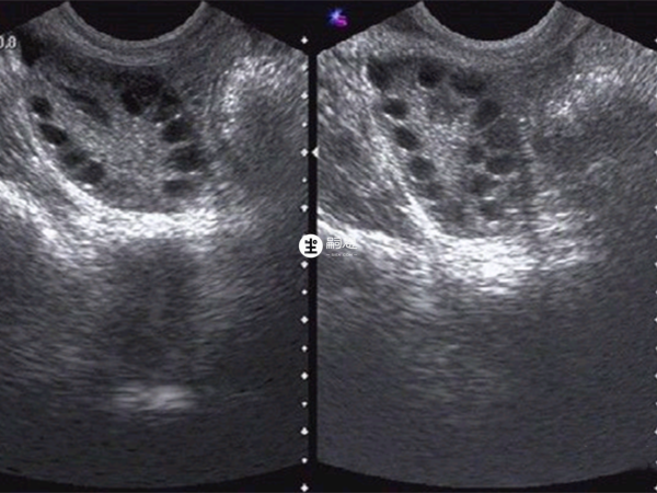 多囊卵巢綜合症是內分泌疾病