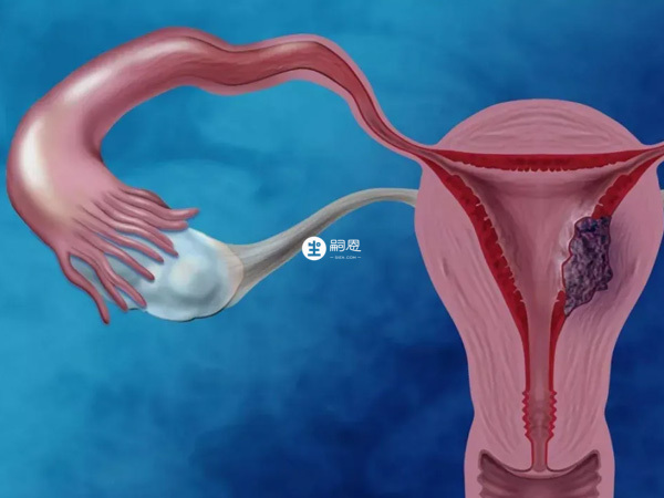 多囊卵巢可選擇中藥調理