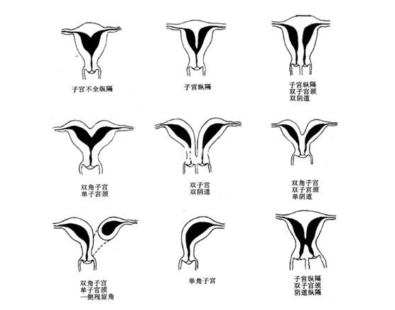 常見的幾種子宮畸形型別