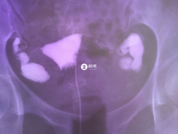 輸卵管積水超過30mm就是嚴重的