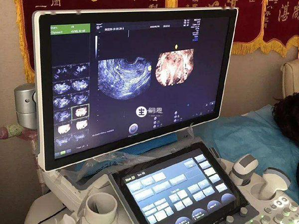 三維超聲是檢查子宮畸形方式之一