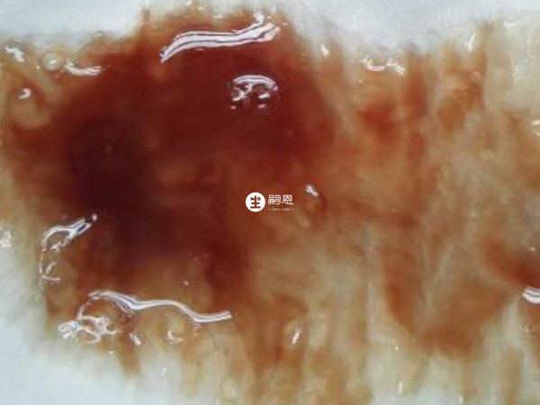 血精是有輕度和重度的區別