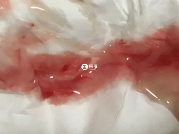 血精一般是由於男性精囊炎引起的