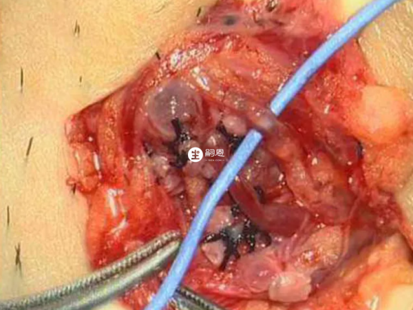 精索靜脈曲張可以通過鍛鍊緩解