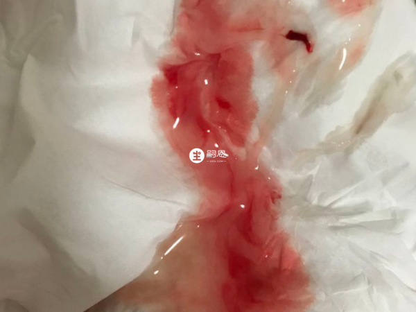 血精一般都是由於精囊炎或者前列腺炎引起的