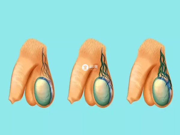 輕度的精索靜脈曲張不需要進行治療