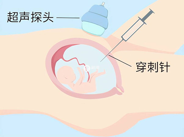 羊水穿刺即羊膜腔穿刺术检查