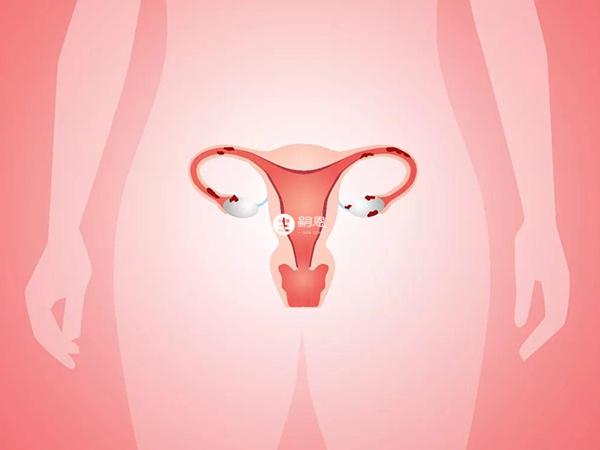 节育环掉落容易导致宫腔逆行性感染
