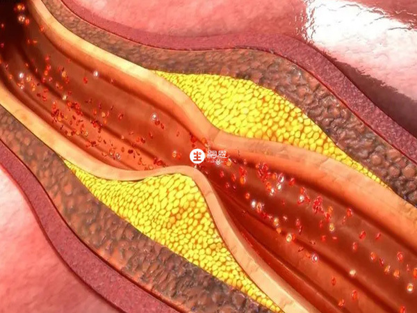 人胎碟片能夠防止動脈粥樣硬化