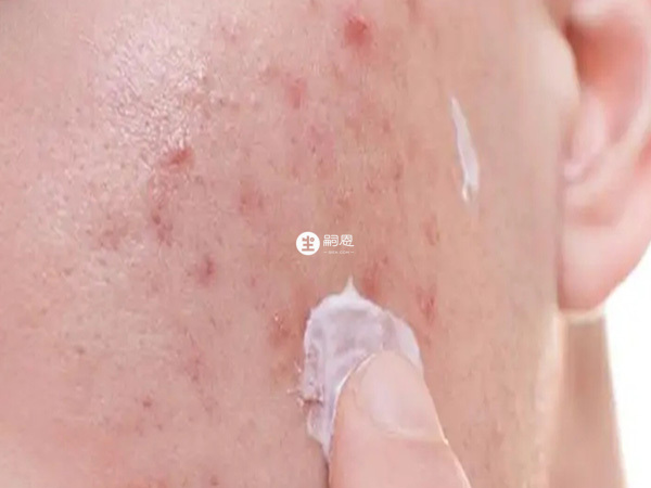 痘肌避孕患者可吃優思悅進行治療