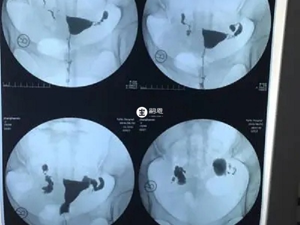 輸卵管造影可能導致女性腹痛