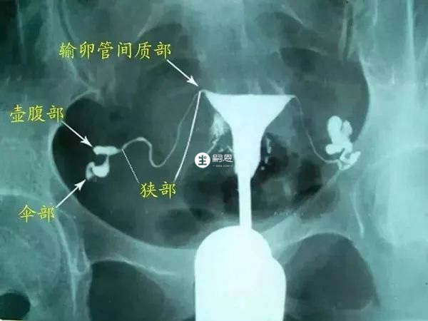 输卵管通畅造影显影图示