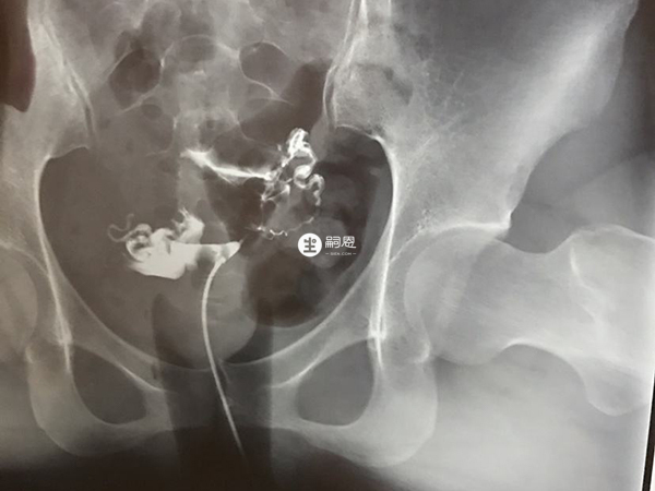 輸卵管通暢才能讓精卵相遇