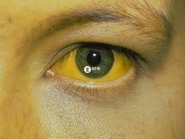 肝功能損傷進一步加重可能出現黃疸