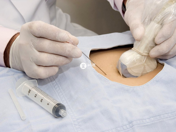 無創有風險可做羊水穿刺