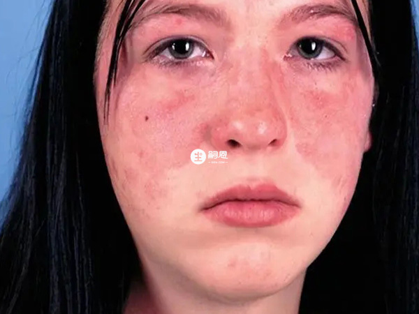 治療紅斑狼瘡等膠原疾病是美卓樂的作用之一