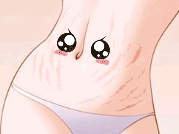 妊娠紋可提前預防