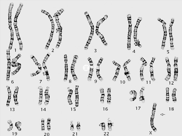 胎兒染色體異常可能會導致出血