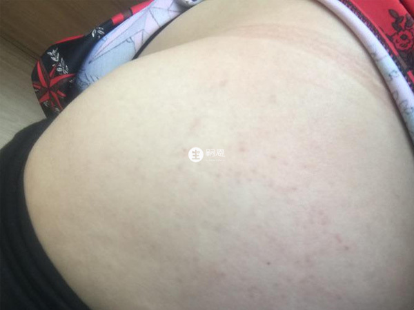 长妊娠纹的前兆图