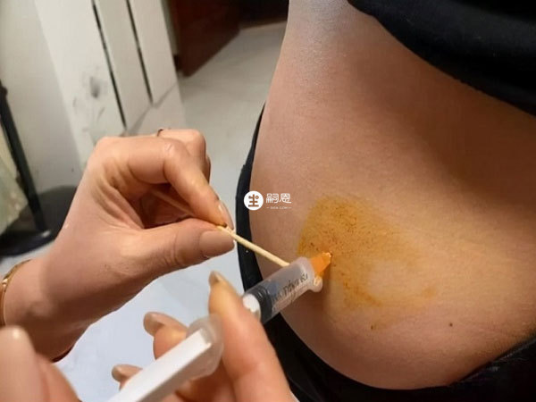 打降調針能夠保證卵子質量